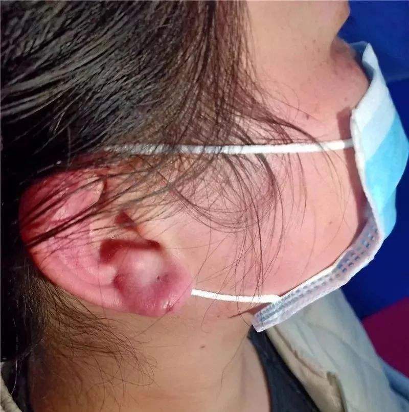 医生耳朵被勒红